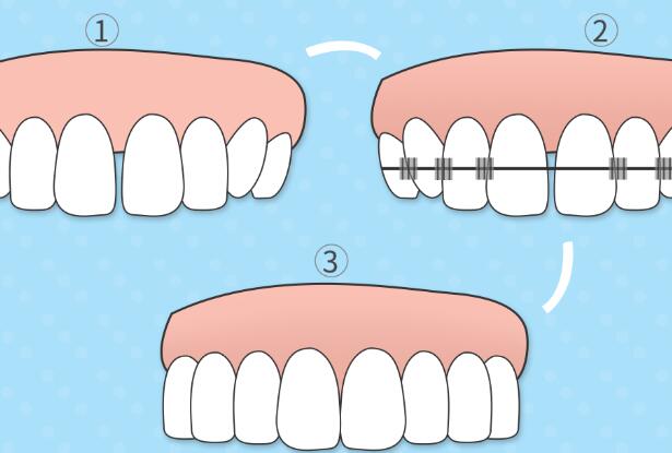 牙齿正畸仅仅是为了好看 为什么做牙齿正畸