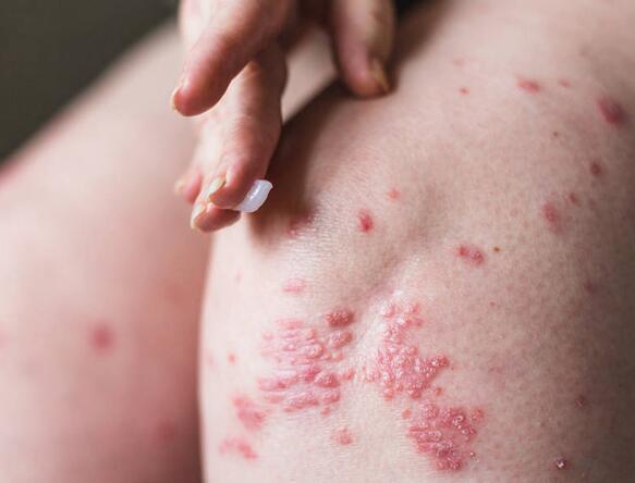 1急性湿疹自觉剧烈瘙痒,皮损多形性红斑丘疹丘疱疹或水疱密集成片,易
