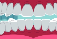 种牙费用有望降低50％ 终于要实现种牙自由了吗