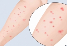 湿疹都是因为环境潮湿引发的吗 湿疹是什么原因造成的